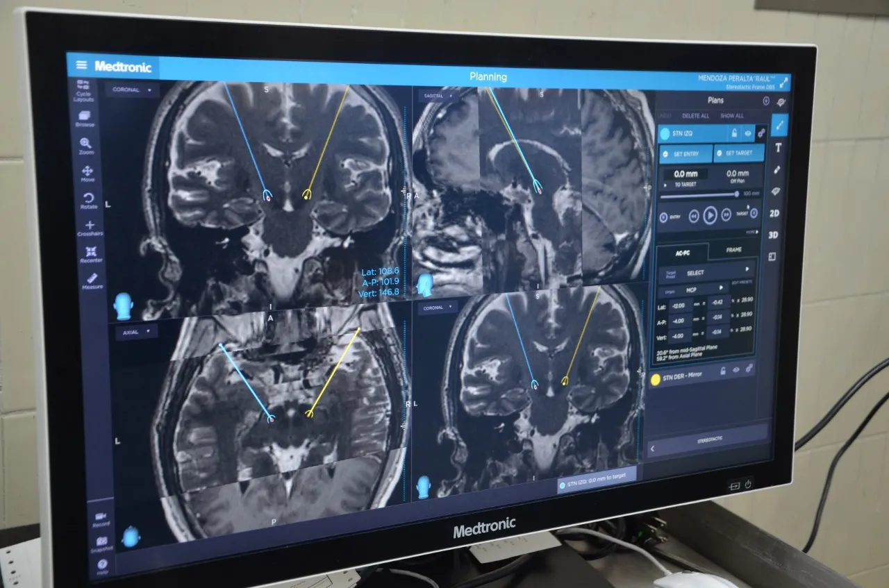 cerebro &#8211; Parkinson
