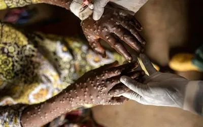 Mpox