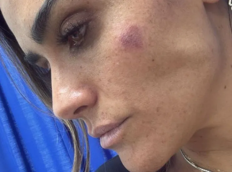 Alessandra Rojo de la Vega muestra las lesiones que sufrió en la Cuauhtémoc
