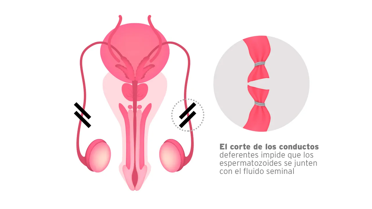 VASECTO