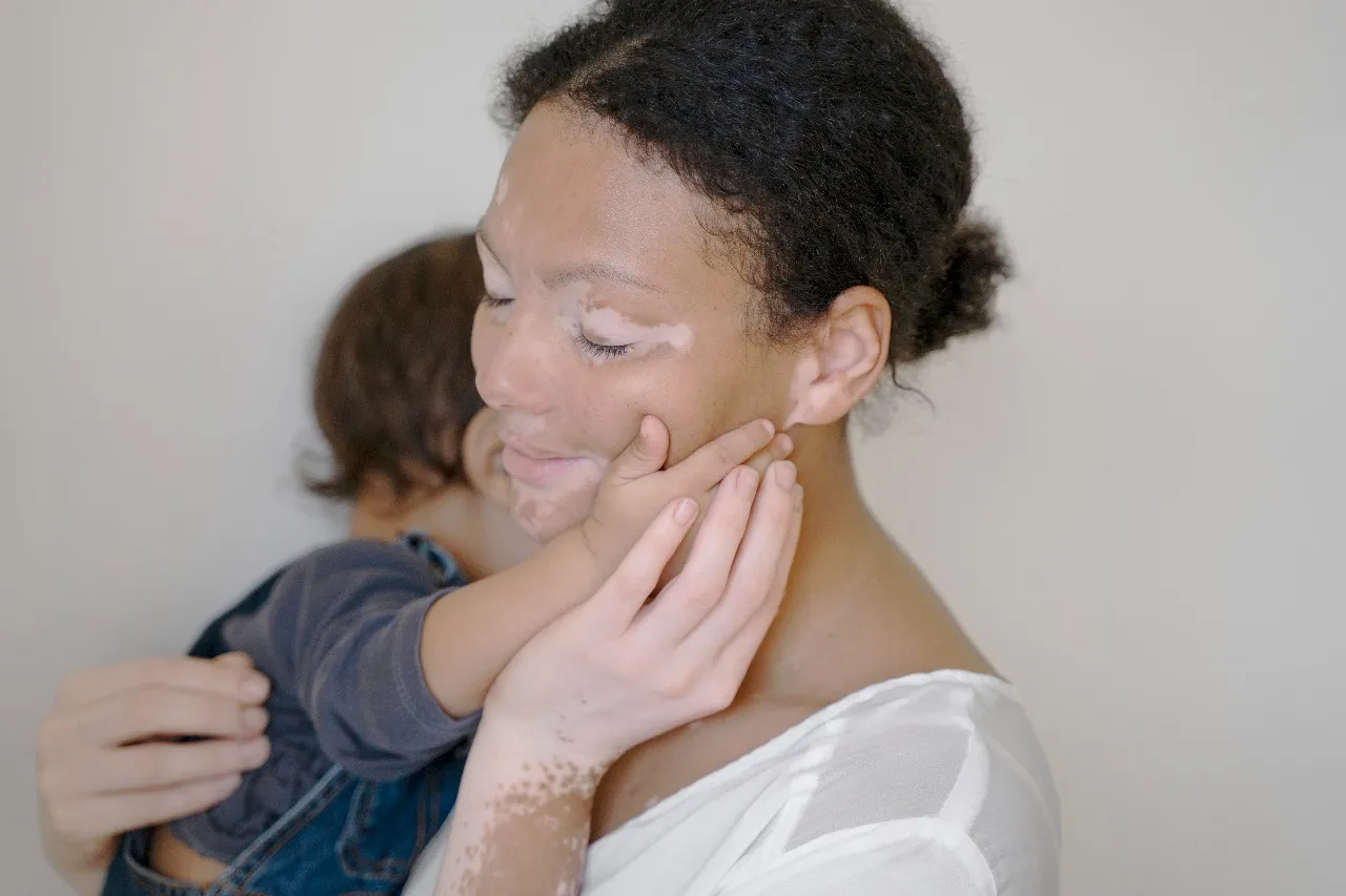 vitiligo
