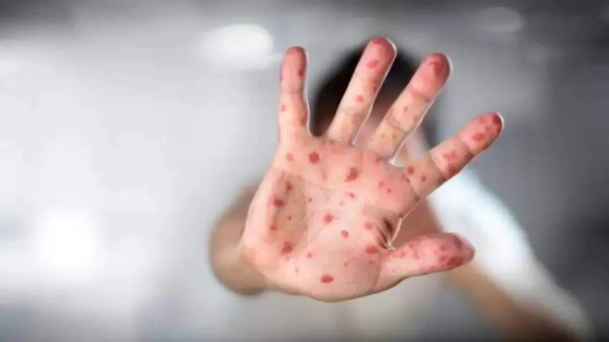 Campaña de vacunación en Sonora ante brote de sarampión