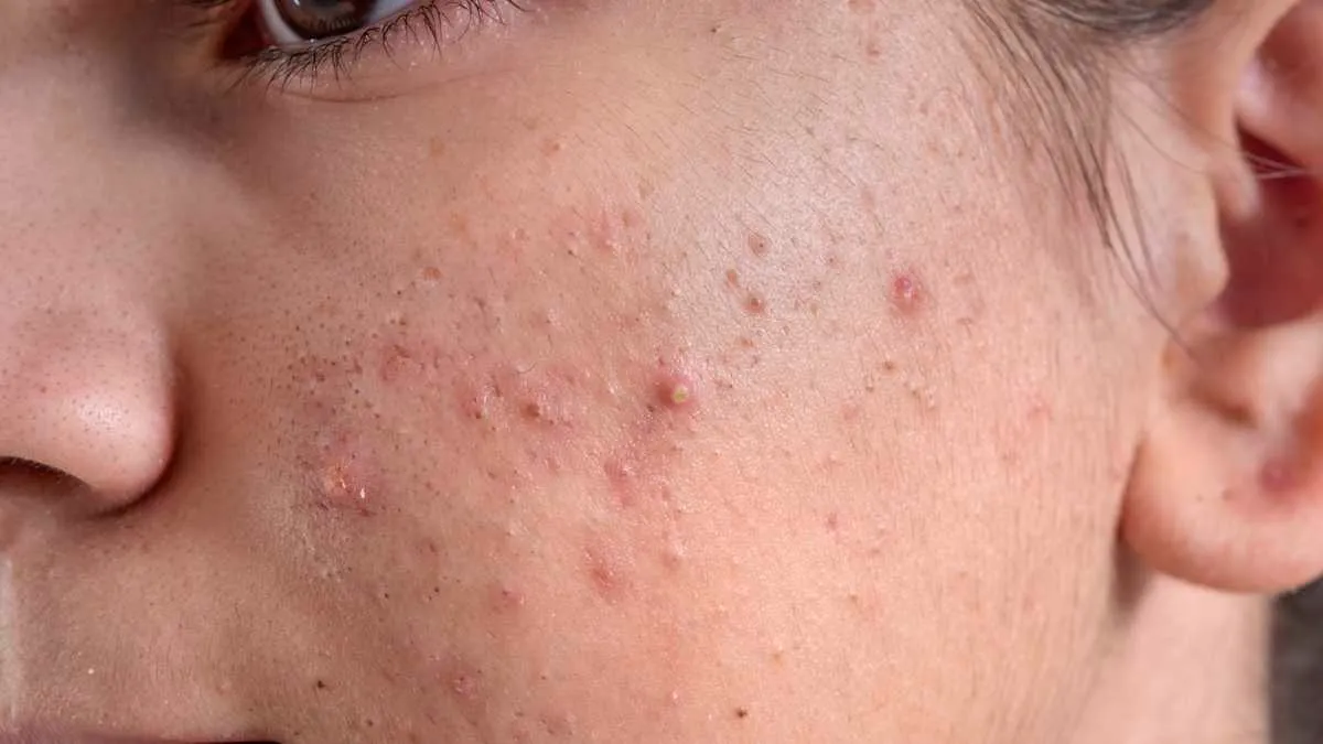 acne