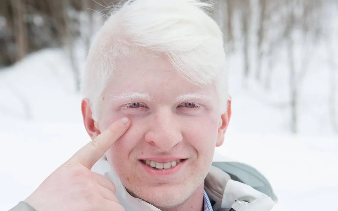 albino