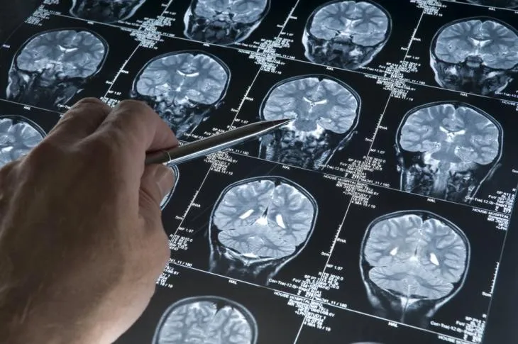 alzheimer