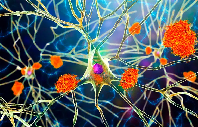 alzheimer
