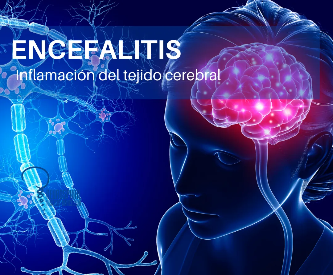 encefalitis
