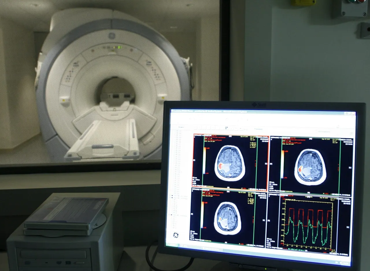 cerebro  alzheimer