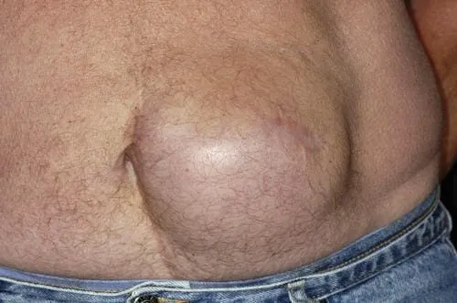 hernia