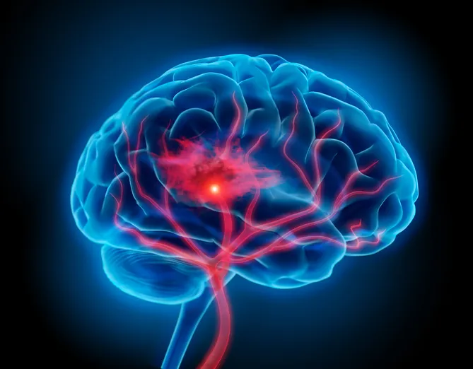 Brain Stroke