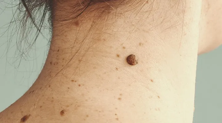 melanoma