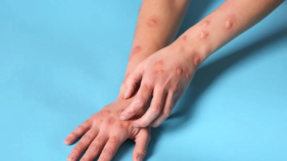 mpox