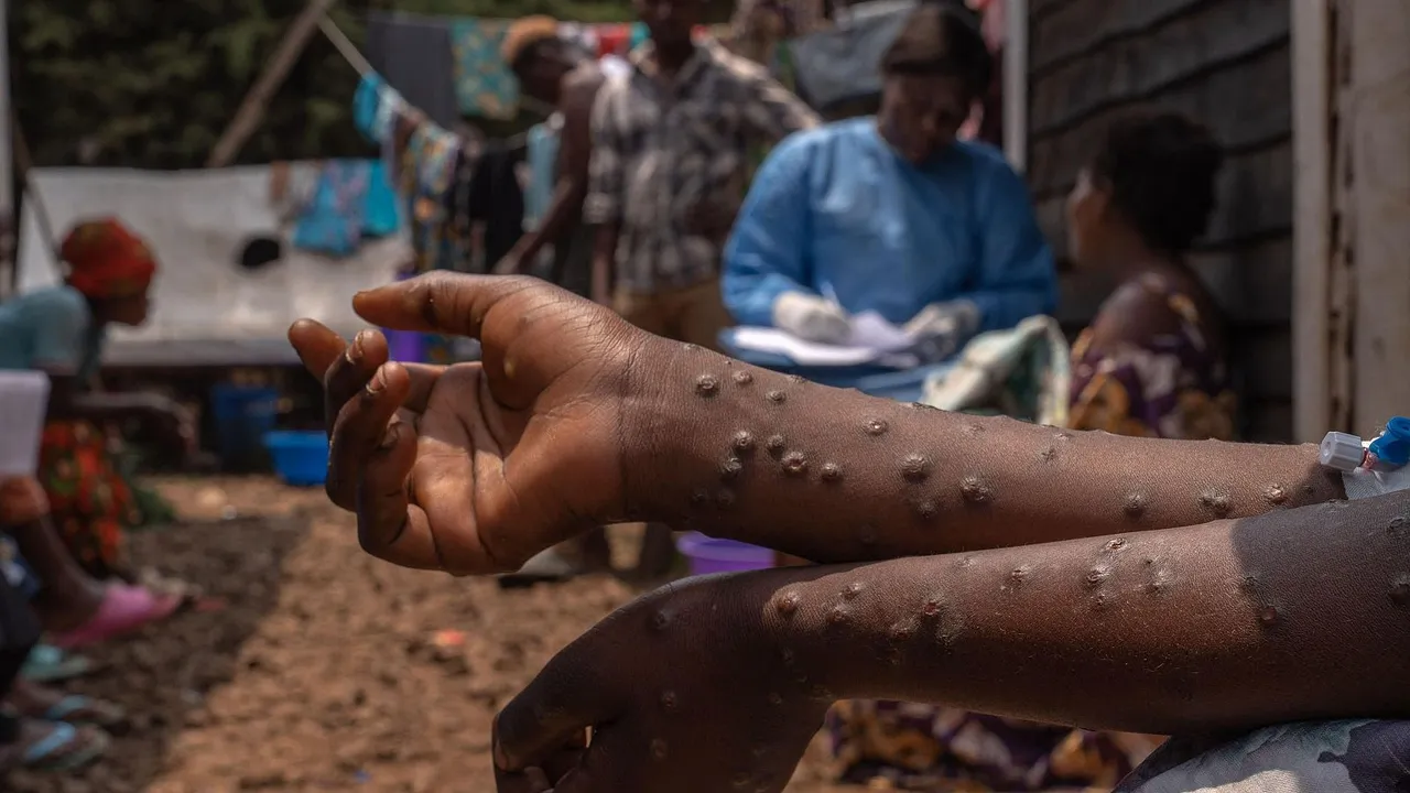 mpox