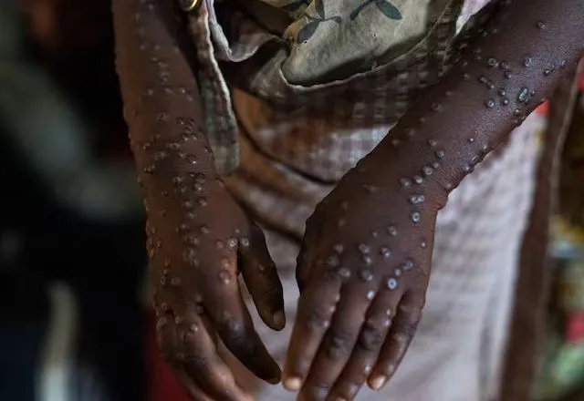 mpox