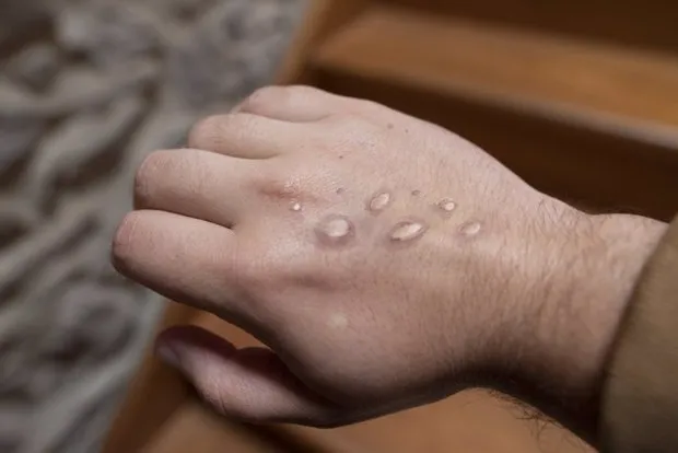 mpox