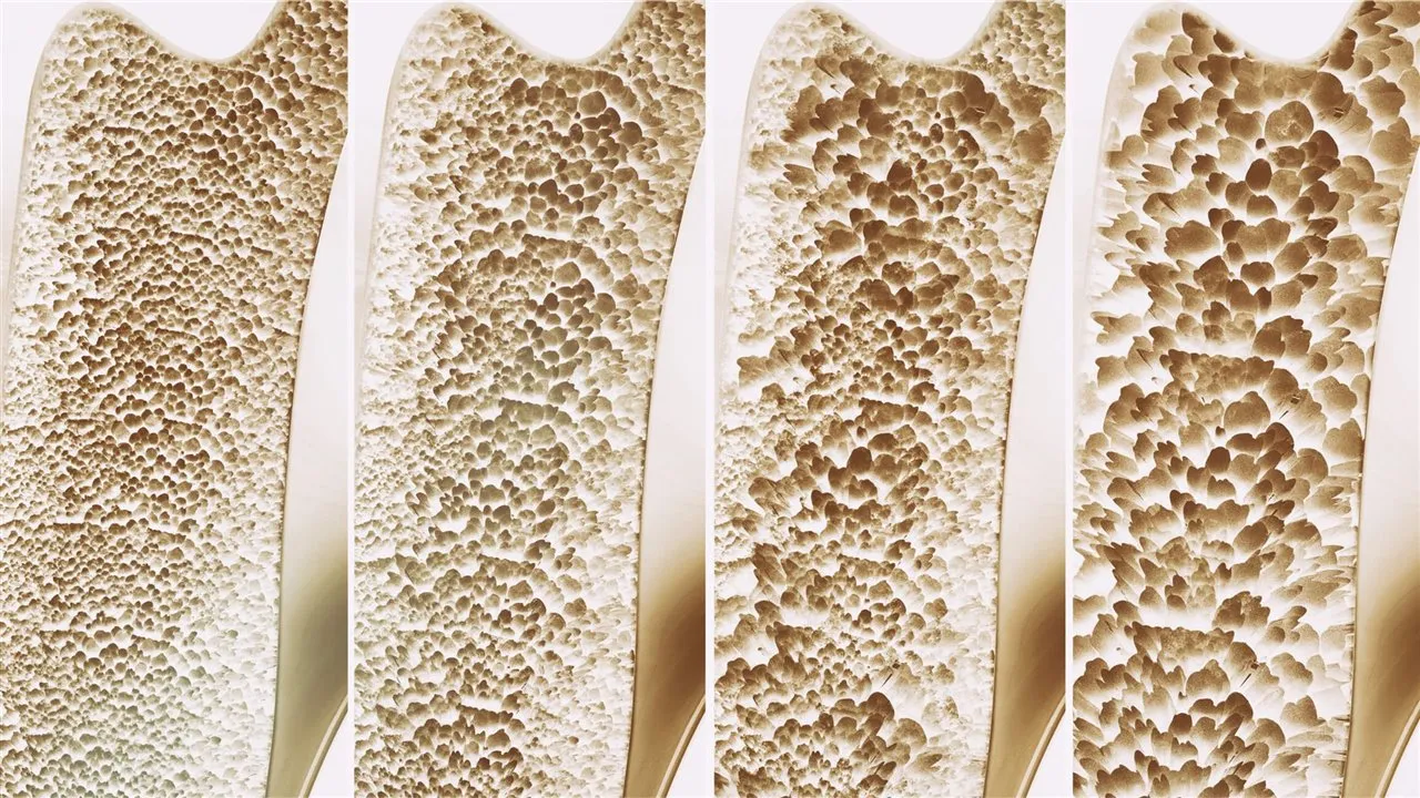 osteporosis