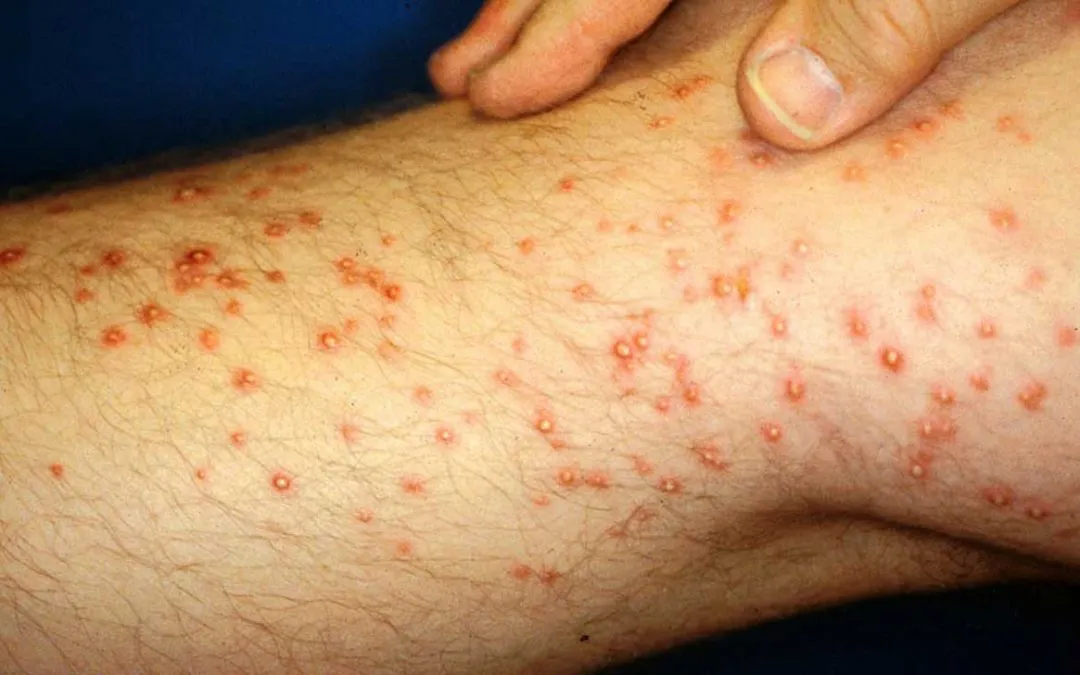 rickettsiosis