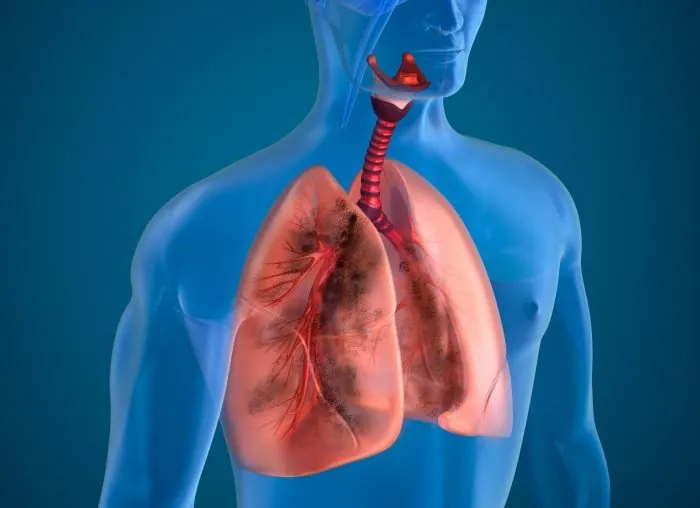 tuberculosis
