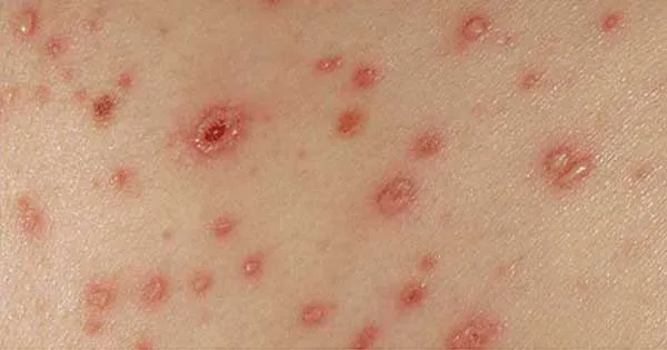 viruela